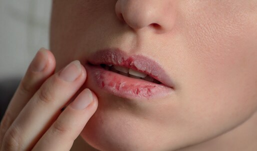 Munnsår eller infeksjoner